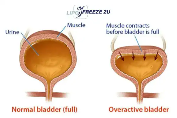 diagram of overactive bladder treatment Southend-on-Sea