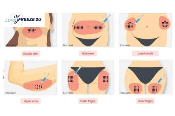 Benefits of Choosing Aqualyx for Fat Reduction Southend-on-Sea