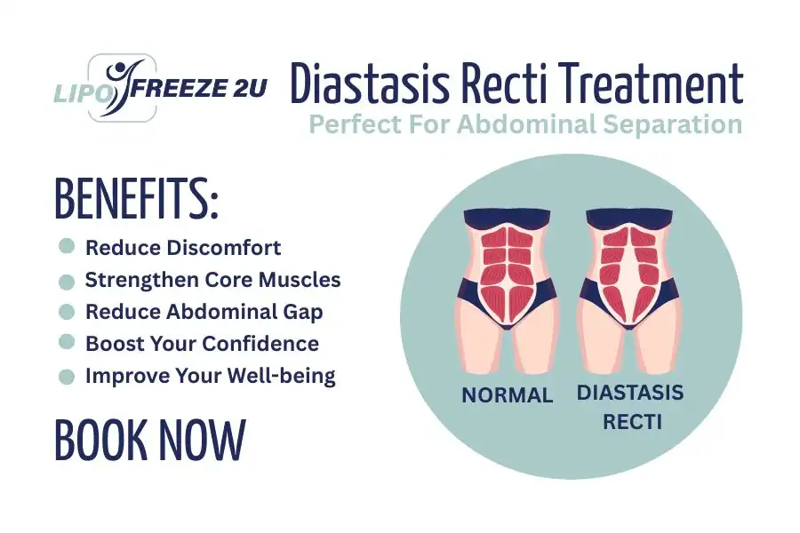 How Long Will It Take to See Improvements in Diastasis Recti Southend-on-Sea
