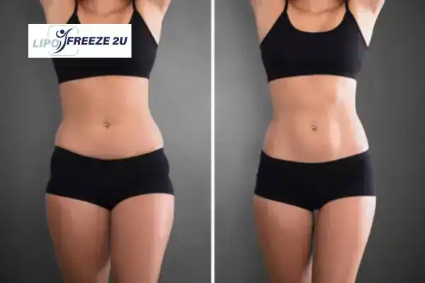 How Can LIPO FREEZE 2U Support Your Post-Pregnancy Body Recovery Southend-on-Sea?