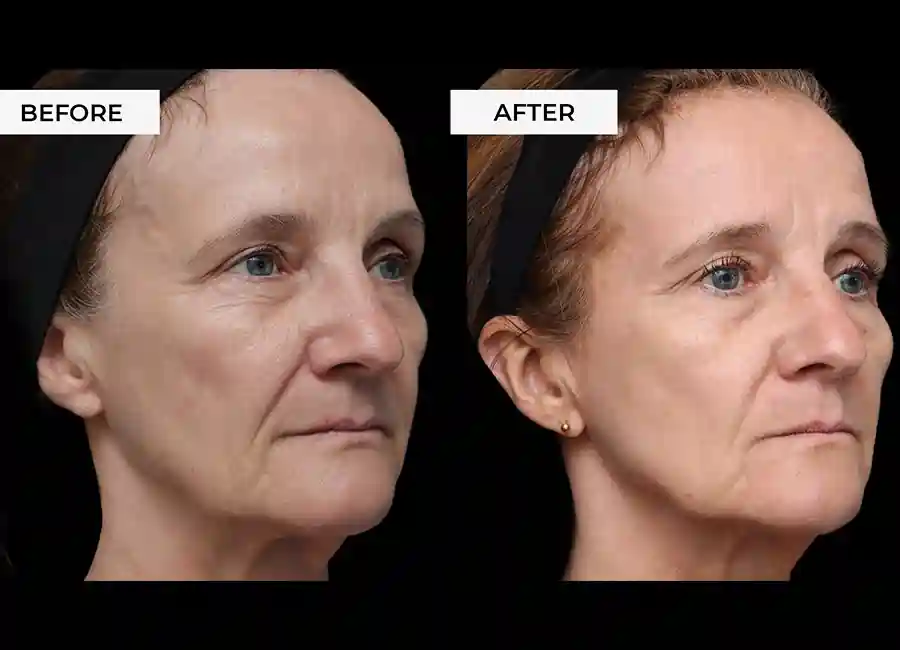 How Many RF Microneedling Sessions Will You Need to See a Difference Southend-on-Sea?