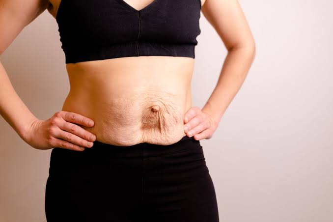 Is Surgery Really the Only Way to Repair Diastasis Recti Southend-on-Sea?