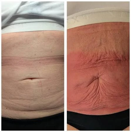 How Does RF Microneedling Improve Crepey, Thin and Uneven Skin Texture Southend-on-Sea?