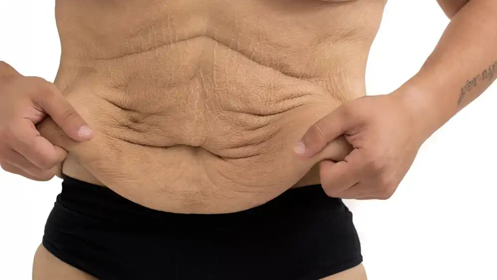 RF Microneedling for Loose Skin: How Can It Help Tighten and Reshape the Skin Southend-on-Sea?
